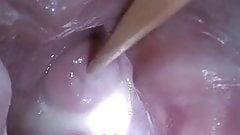 Insertion Semen Cum in Cervix Wide Stretching Pussy Speculum