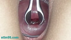 Cervix stretching wide with speculum and sperm in uterus